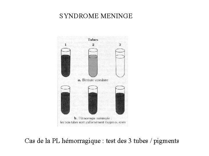 SYNDROME MENINGE Cas de la PL hémorragique : test des 3 tubes / pigments