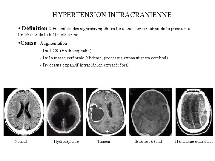 HYPERTENSION INTRACRANIENNE • Définition : Ensemble des signes/symptômes lié à une augmentation de la