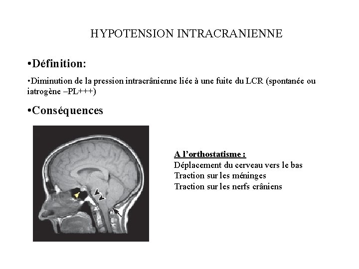 HYPOTENSION INTRACRANIENNE • Définition: • Diminution de la pression intracrânienne liée à une fuite