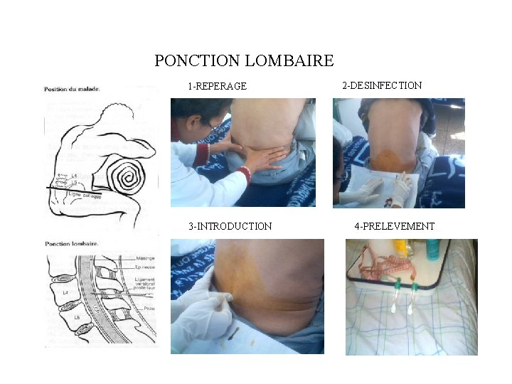 PONCTION LOMBAIRE 1 -REPERAGE 3 -INTRODUCTION 2 -DESINFECTION 4 -PRELEVEMENT 