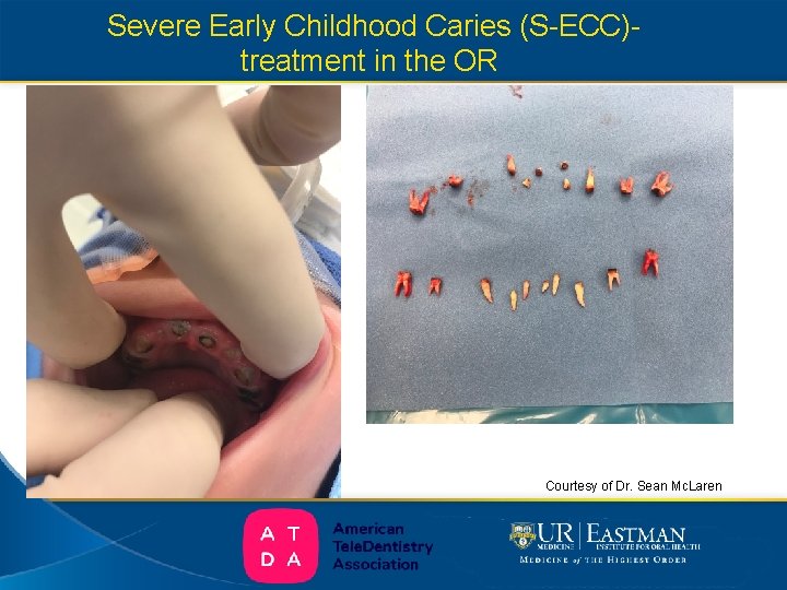  Severe Early Childhood Caries (S-ECC)treatment in the OR Courtesy of Dr. Sean Mc.