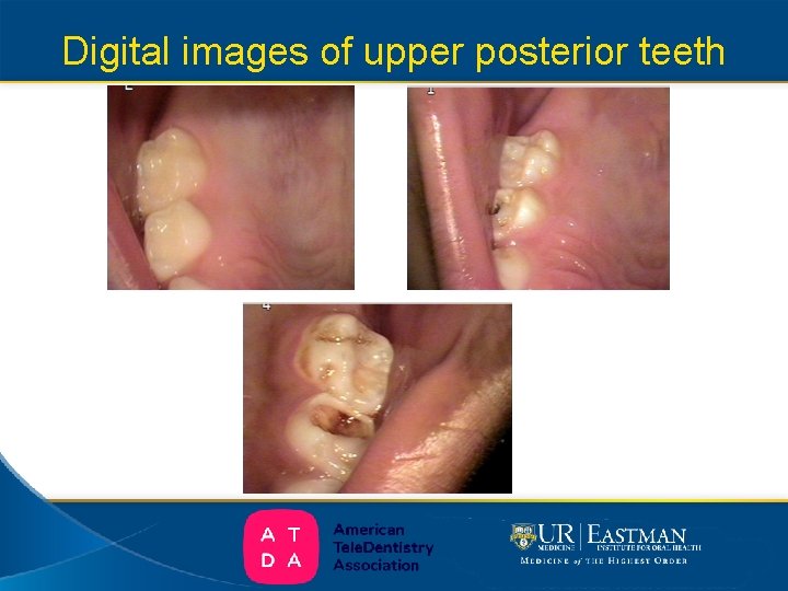 Digital images of upper posterior teeth 