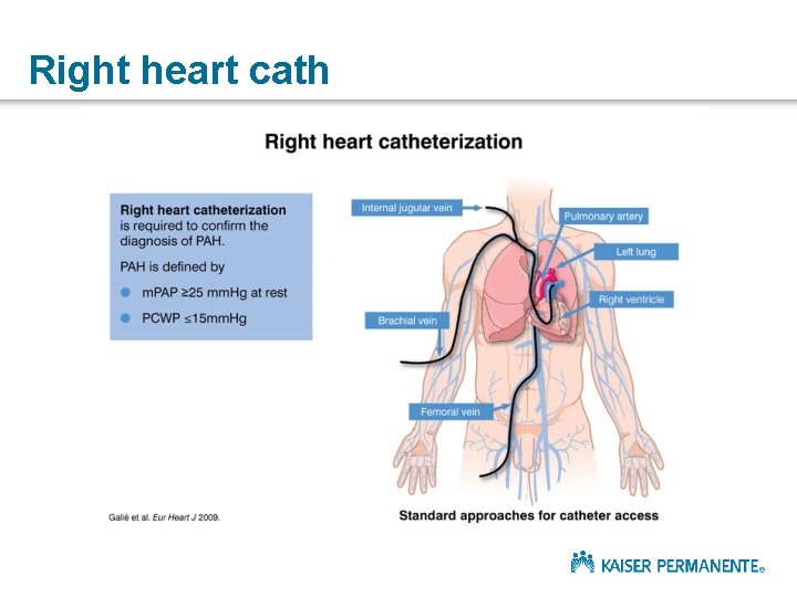 Right heart cath 