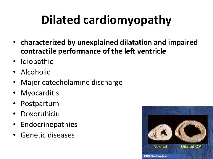 Dilated cardiomyopathy • characterized by unexplained dilatation and impaired contractile performance of the left