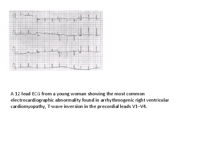 A 12 -lead ECG from a young woman showing the most common electrocardiographic abnormality