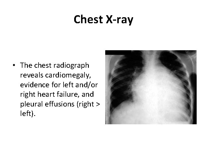 Chest X-ray • The chest radiograph reveals cardiomegaly, evidence for left and/or right heart