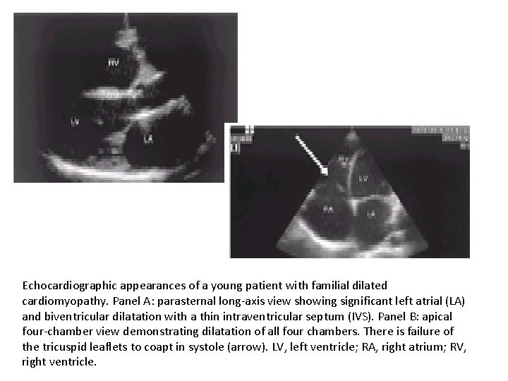 Echocardiographic appearances of a young patient with familial dilated cardiomyopathy. Panel A: parasternal long-axis