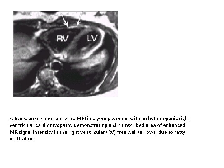 A transverse plane spin-echo MRI in a young woman with arrhythmogenic right ventricular cardiomyopathy