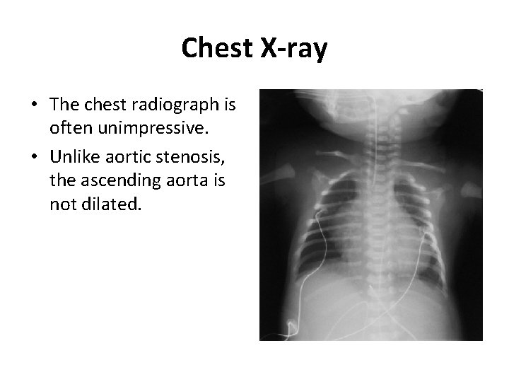 Chest X-ray • The chest radiograph is often unimpressive. • Unlike aortic stenosis, the