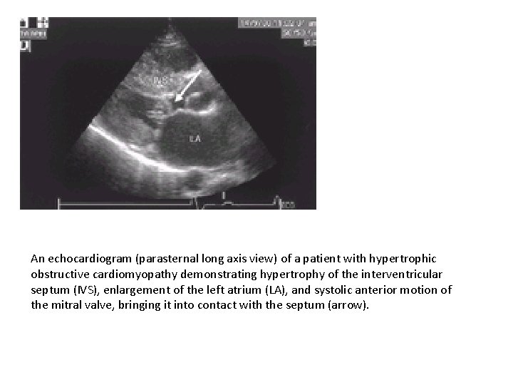 An echocardiogram (parasternal long axis view) of a patient with hypertrophic obstructive cardiomyopathy demonstrating