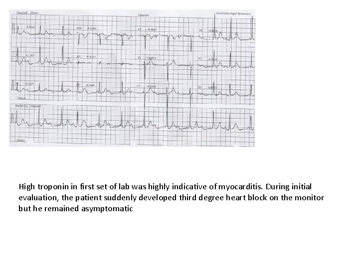 High troponin in first set of lab was highly indicative of myocarditis. During initial