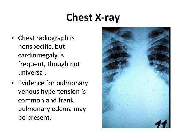 Chest X-ray • Chest radiograph is nonspecific, but cardiomegaly is frequent, though not universal.