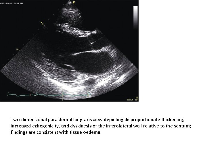 Two-dimensional parasternal long-axis view depicting disproportionate thickening, increased echogenicity, and dyskinesis of the inferolateral