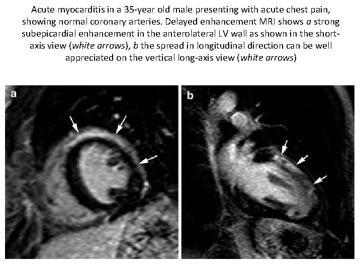 Acute myocarditis in a 35 -year old male presenting with acute chest pain, showing