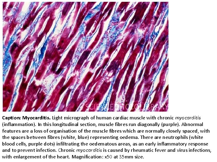 Caption: Myocarditis. Light micrograph of human cardiac muscle with chronic myocarditis (inflammation). In this