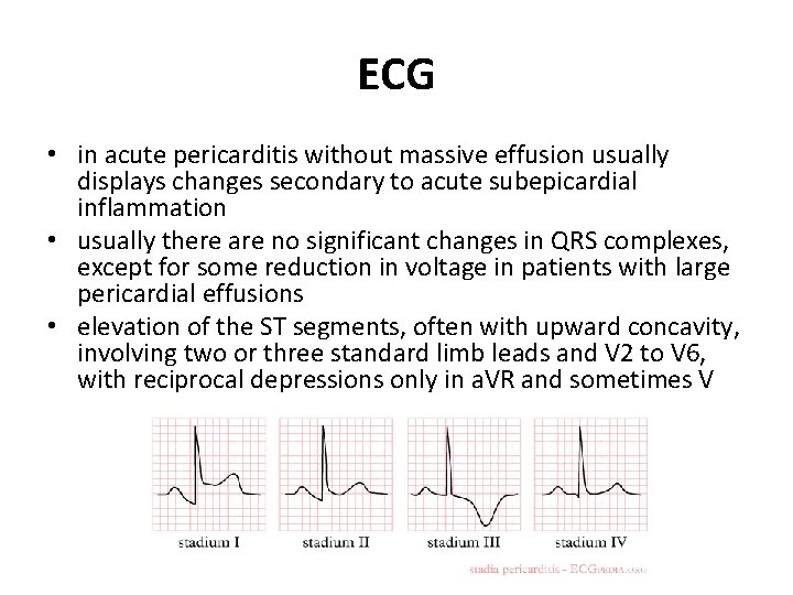 ECG • in acute pericarditis without massive effusion usually displays changes secondary to acute