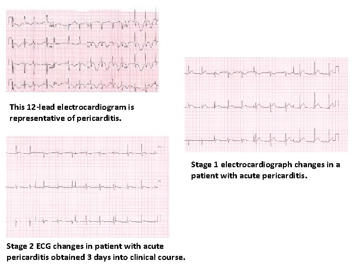 This 12 -lead electrocardiogram is representative of pericarditis. Stage 1 electrocardiograph changes in a