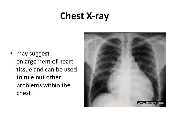 Chest X-ray • may suggest enlargement of heart tissue and can be used to