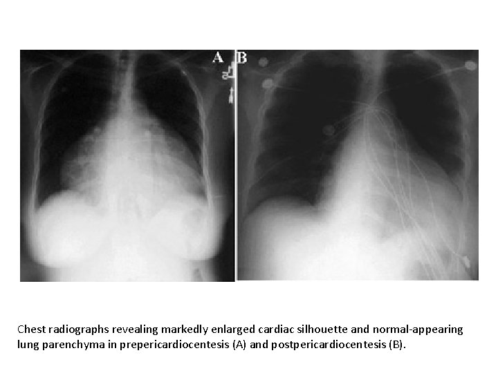 Chest radiographs revealing markedly enlarged cardiac silhouette and normal-appearing lung parenchyma in prepericardiocentesis (A)