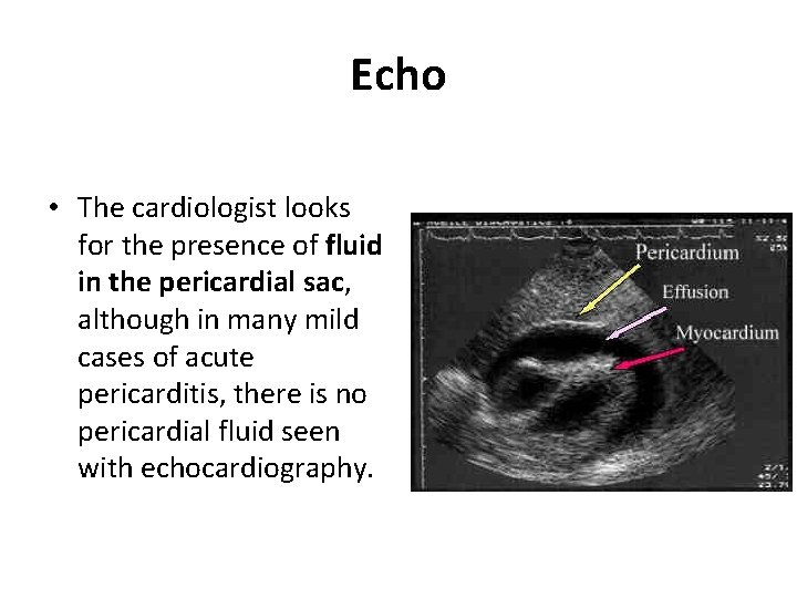 Echo • The cardiologist looks for the presence of fluid in the pericardial sac,