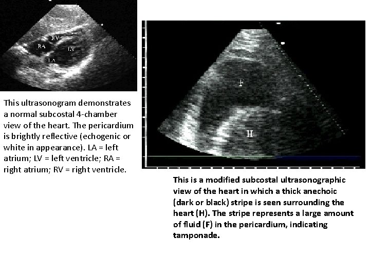 This ultrasonogram demonstrates a normal subcostal 4 -chamber view of the heart. The pericardium