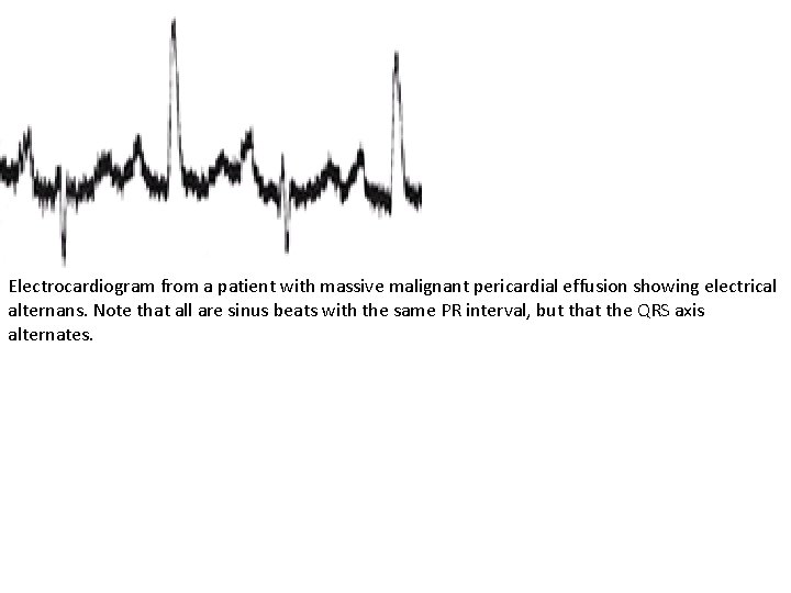 Electrocardiogram from a patient with massive malignant pericardial effusion showing electrical alternans. Note that