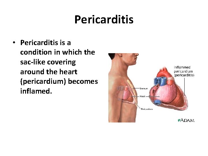 Pericarditis • Pericarditis is a condition in which the sac-like covering around the heart