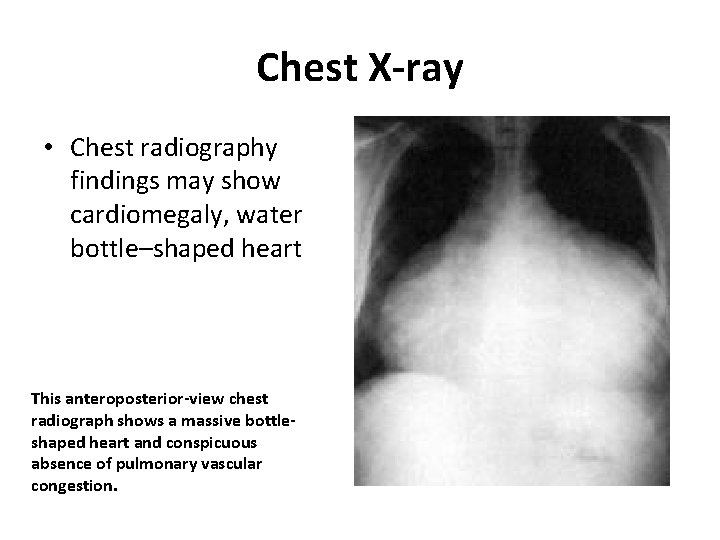 Chest X-ray • Chest radiography findings may show cardiomegaly, water bottle–shaped heart This anteroposterior-view