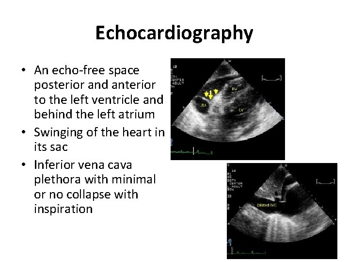 Echocardiography • An echo-free space posterior and anterior to the left ventricle and behind