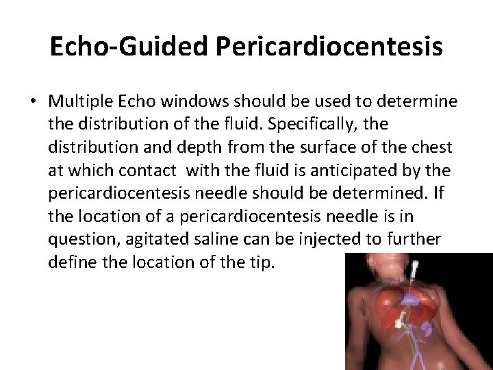 Echo-Guided Pericardiocentesis • Multiple Echo windows should be used to determine the distribution of