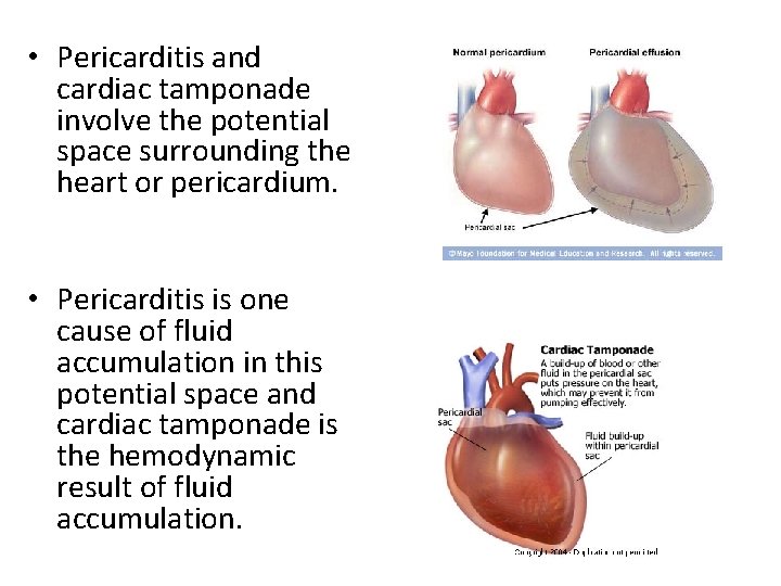  • Pericarditis and cardiac tamponade involve the potential space surrounding the heart or