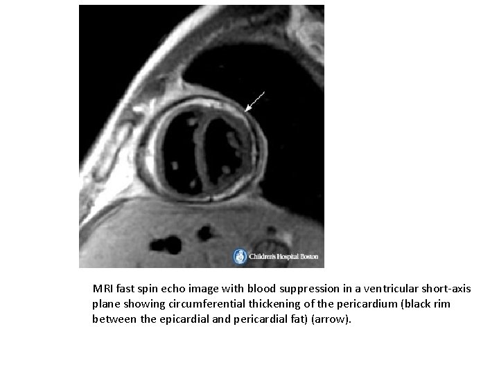 MRI fast spin echo image with blood suppression in a ventricular short-axis plane showing