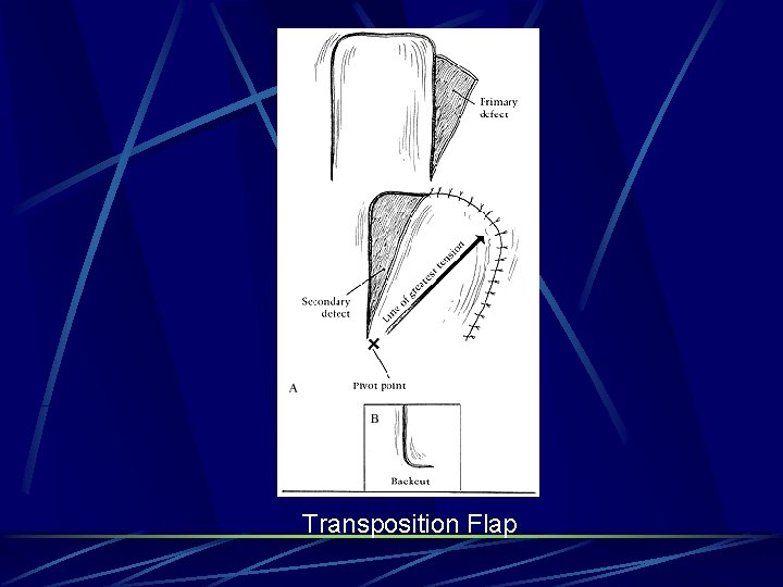 Transposition Flap Transposition Flap