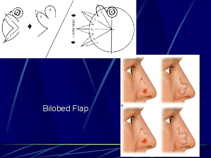 Bilobed Flap Bilobed Flap