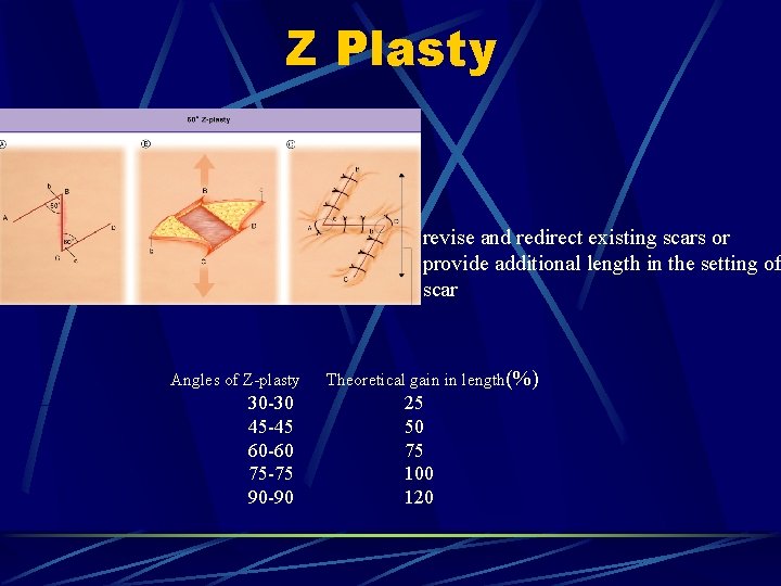 Z Plasty revise and redirect existing scars or provide additional length in the setting Z Plasty revise and redirect existing scars or provide additional length in the setting