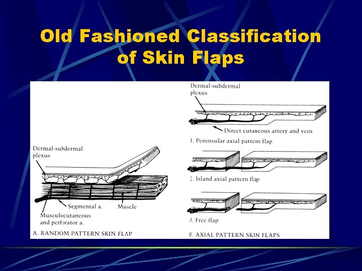 Old Fashioned Classification of Skin Flaps Old Fashioned Classification of Skin Flaps