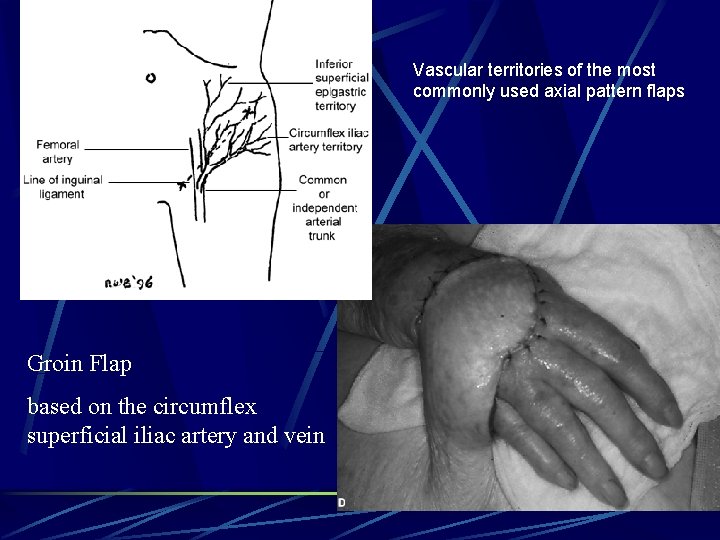 Vascular territories of the most commonly used axial pattern flaps Groin Flap based on Vascular territories of the most commonly used axial pattern flaps Groin Flap based on