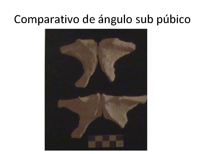 Comparativo de ángulo sub púbico 