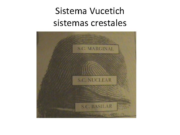 Sistema Vucetich sistemas crestales 