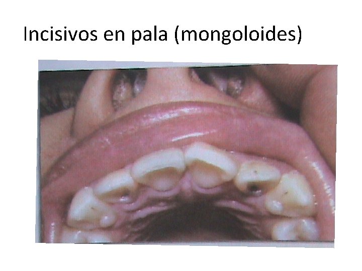 Incisivos en pala (mongoloides) 