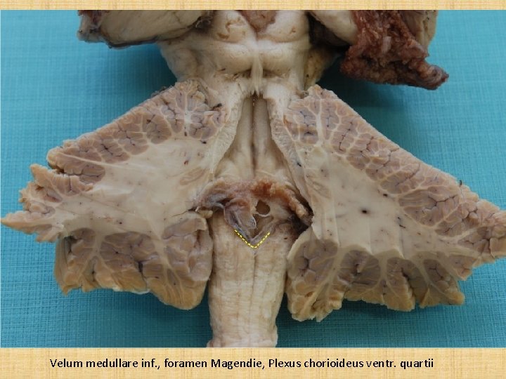 Velum medullare inf. , foramen Magendie, Plexus chorioideus ventr. quartii 