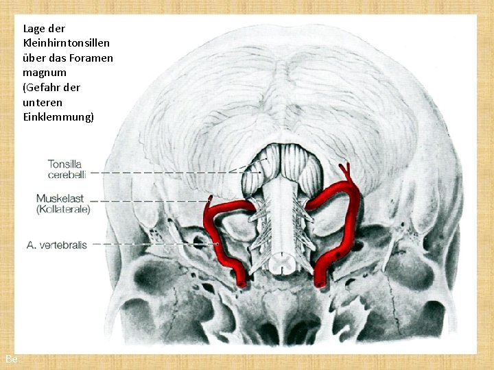 Lage der Kleinhirntonsillen über das Foramen magnum (Gefahr der unteren Einklemmung) Be 