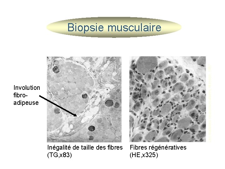 Les maladies neuromusculaires, Masson, 1997 Biopsie musculaire Involution fibroadipeuse Inégalité de taille des fibres