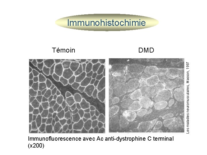  Immunohistochimie DMD Les maladies neuromusculaires, Masson, 1997 Témoin Immunofluorescence avec Ac anti-dystrophine C