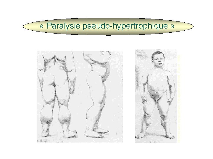 Histoire des myopathies, Delaporte et Pinel, Payot 1998 « Paralysie pseudo-hypertrophique » 