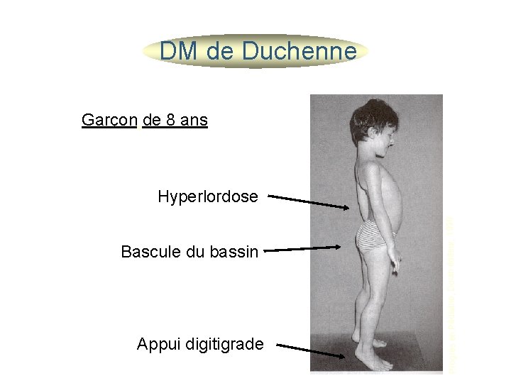 DM de Duchenne Garçon de 8 ans Bascule du bassin Appui digitigrade Progrès en