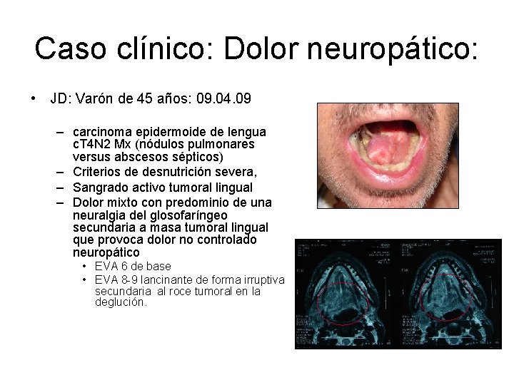 Caso clínico: Dolor neuropático: • JD: Varón de 45 años: 09. 04. 09 –
