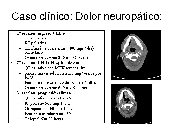 Caso clínico: Dolor neuropático: • 1º escalón: ingreso + PEG – dexametasona • •