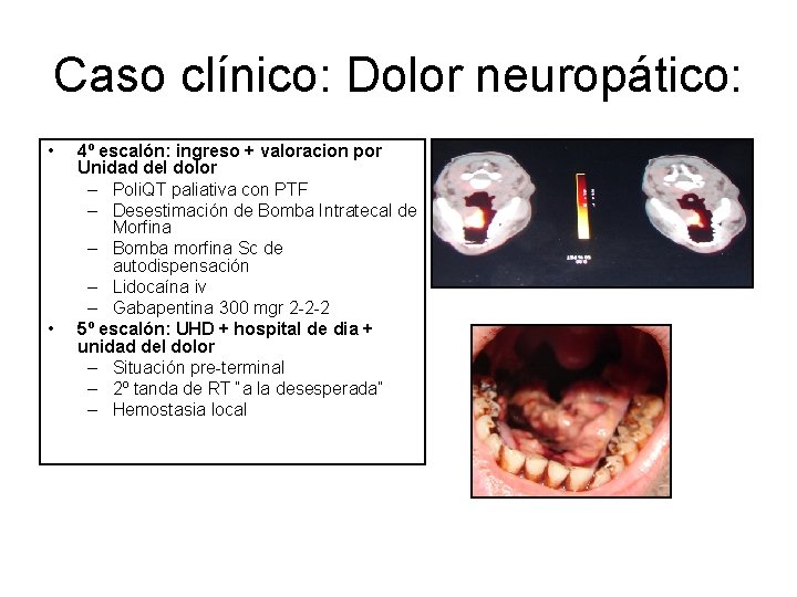 Caso clínico: Dolor neuropático: • • 4º escalón: ingreso + valoracion por Unidad del