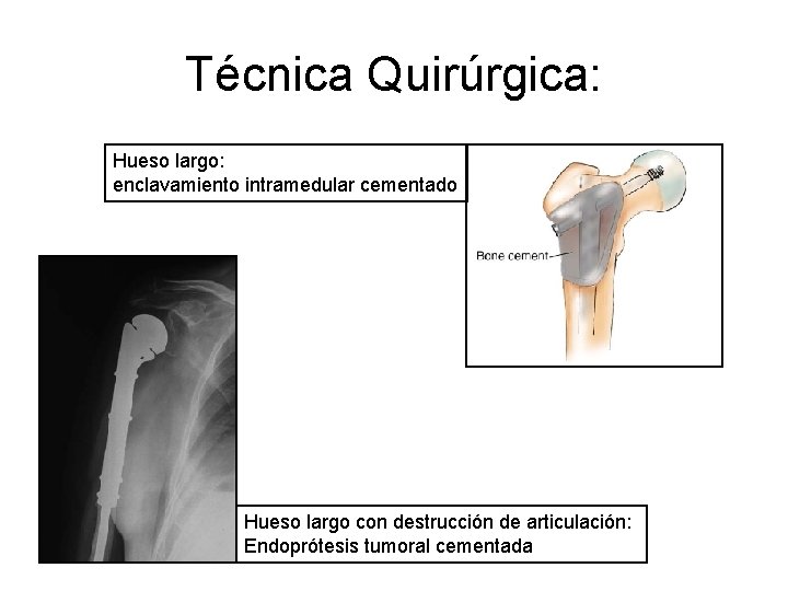 Técnica Quirúrgica: Hueso largo: enclavamiento intramedular cementado Hueso largo con destrucción de articulación: Endoprótesis